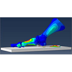 Finite element model in Abaqus of a foot, showing stresses in the first metatarsophalangeal joint (the big toe) 