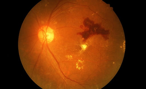 Retina of a person with diabetic retinopathy